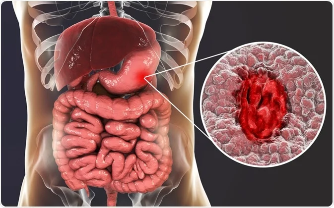 How to Sleep With Stomach Ulcer