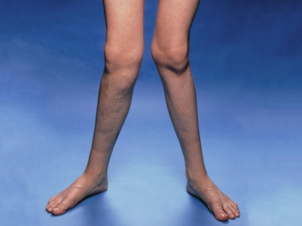 Varus vs Valgus Knee